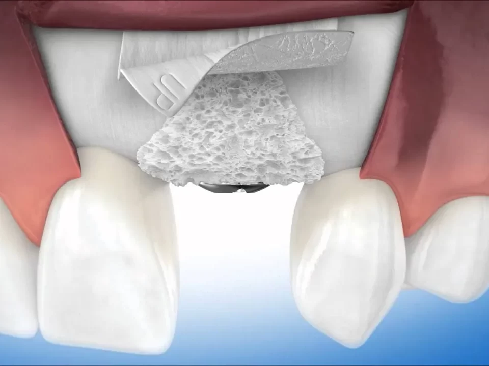 Optimalkan Regenerasi Tulang Gigi dengan Bone Graft dan Batan Bran