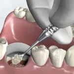 Socket Preservation, Cara Efektif Menjaga Struktur Tulang Alveolar Setelah Cabut Gigi